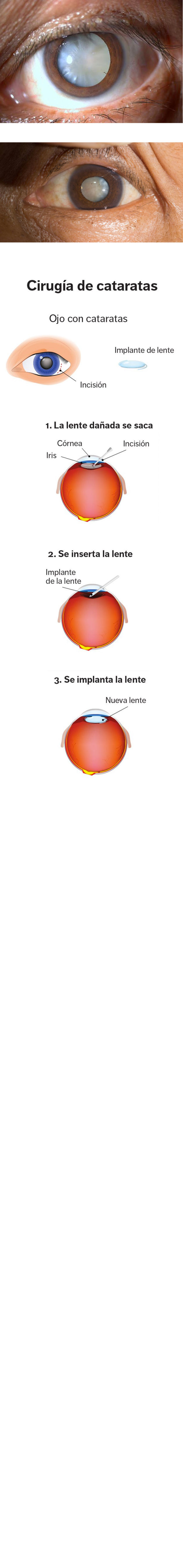 Cirugía de catarata