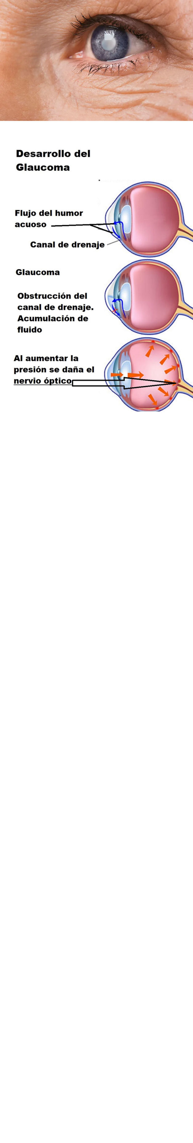 Cirugía de catarata