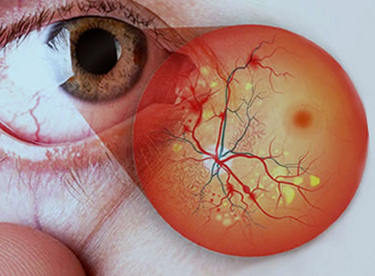Retinopatía Diabética