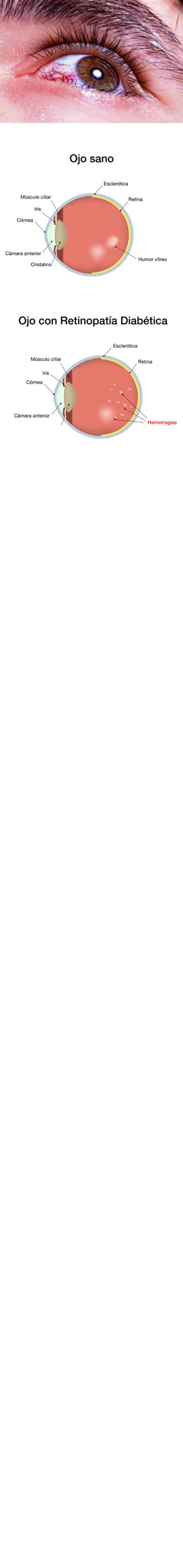 Retinopatía diabética